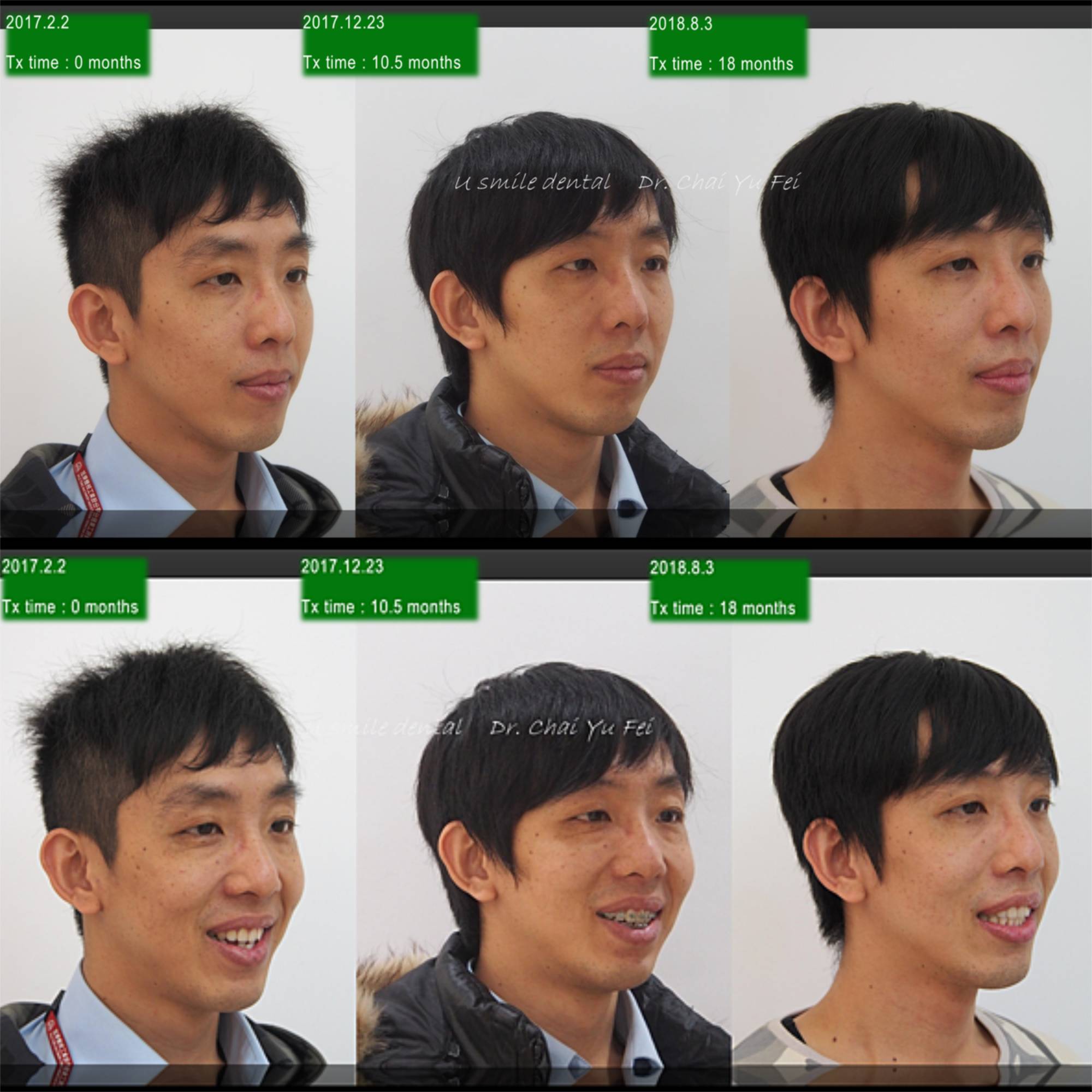 不拔牙戽斗矯正案例