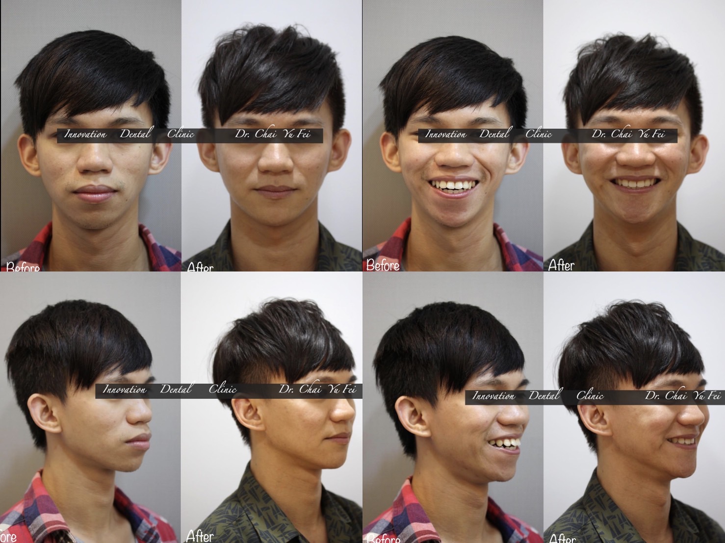 拔牙暴牙露牙齦矯正案例