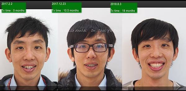 不拔牙靠骨釘也可讓全齒列後退！齒性三類咬合戽斗案例-吳先生