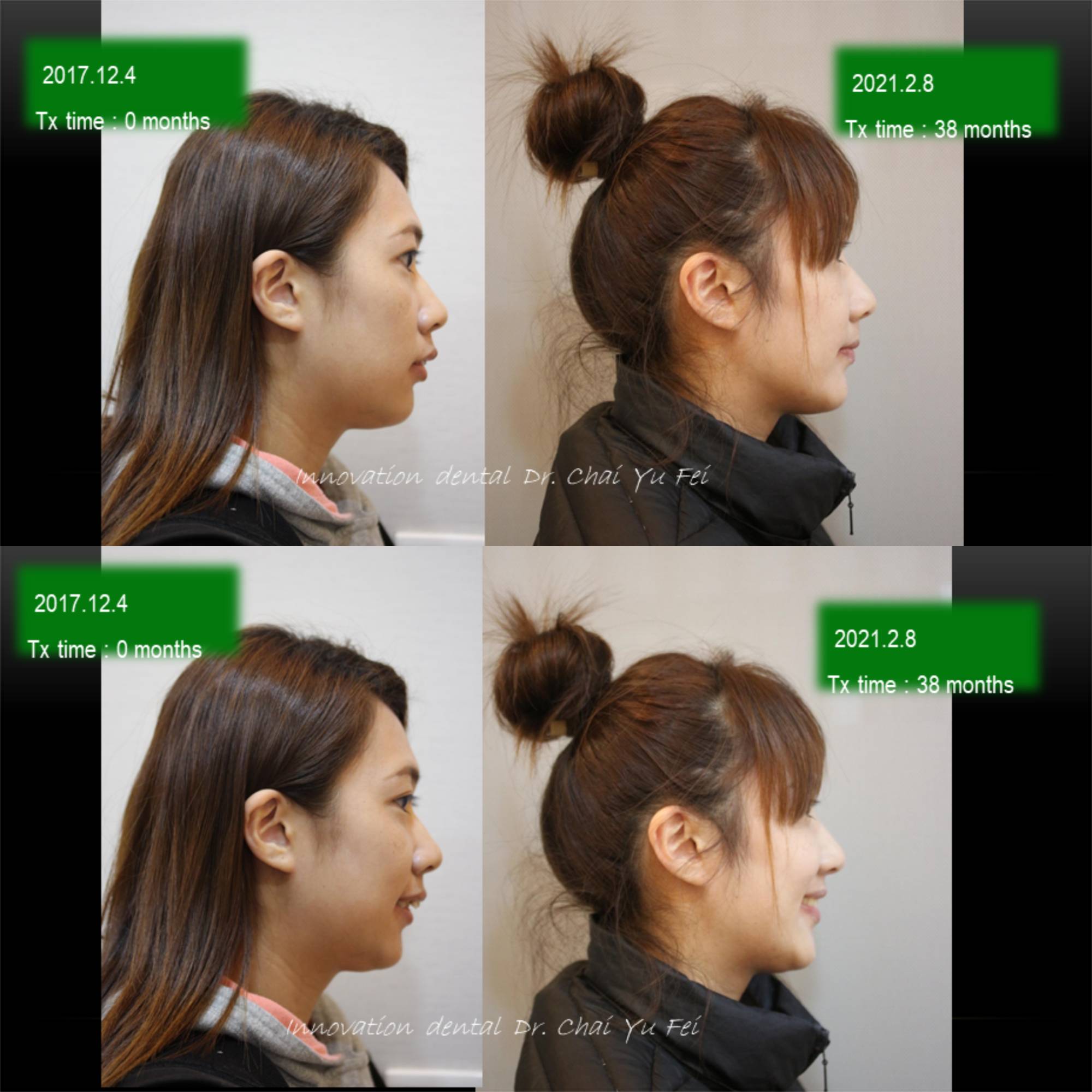 拔牙矯正案例分享