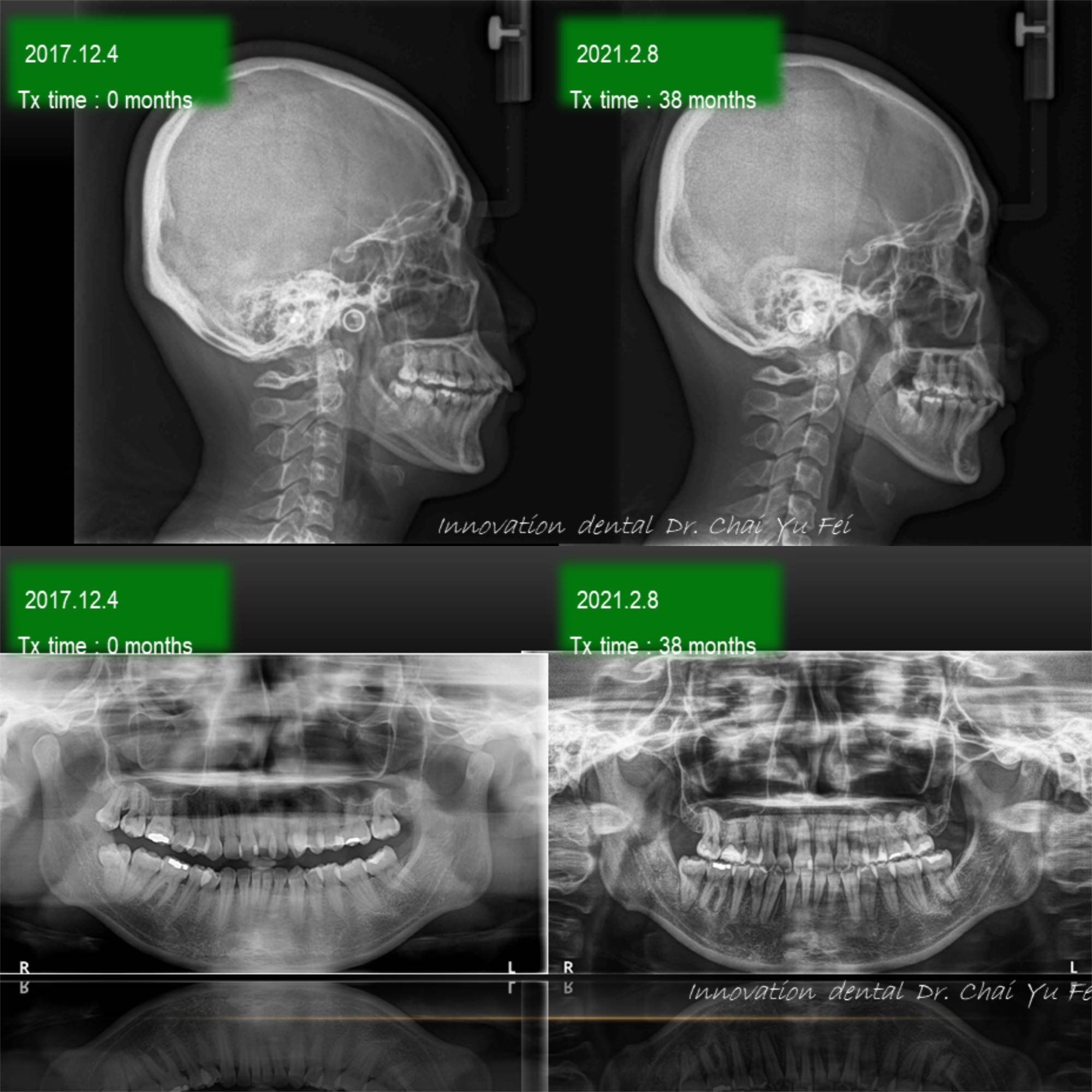 拔牙矯正案例X光