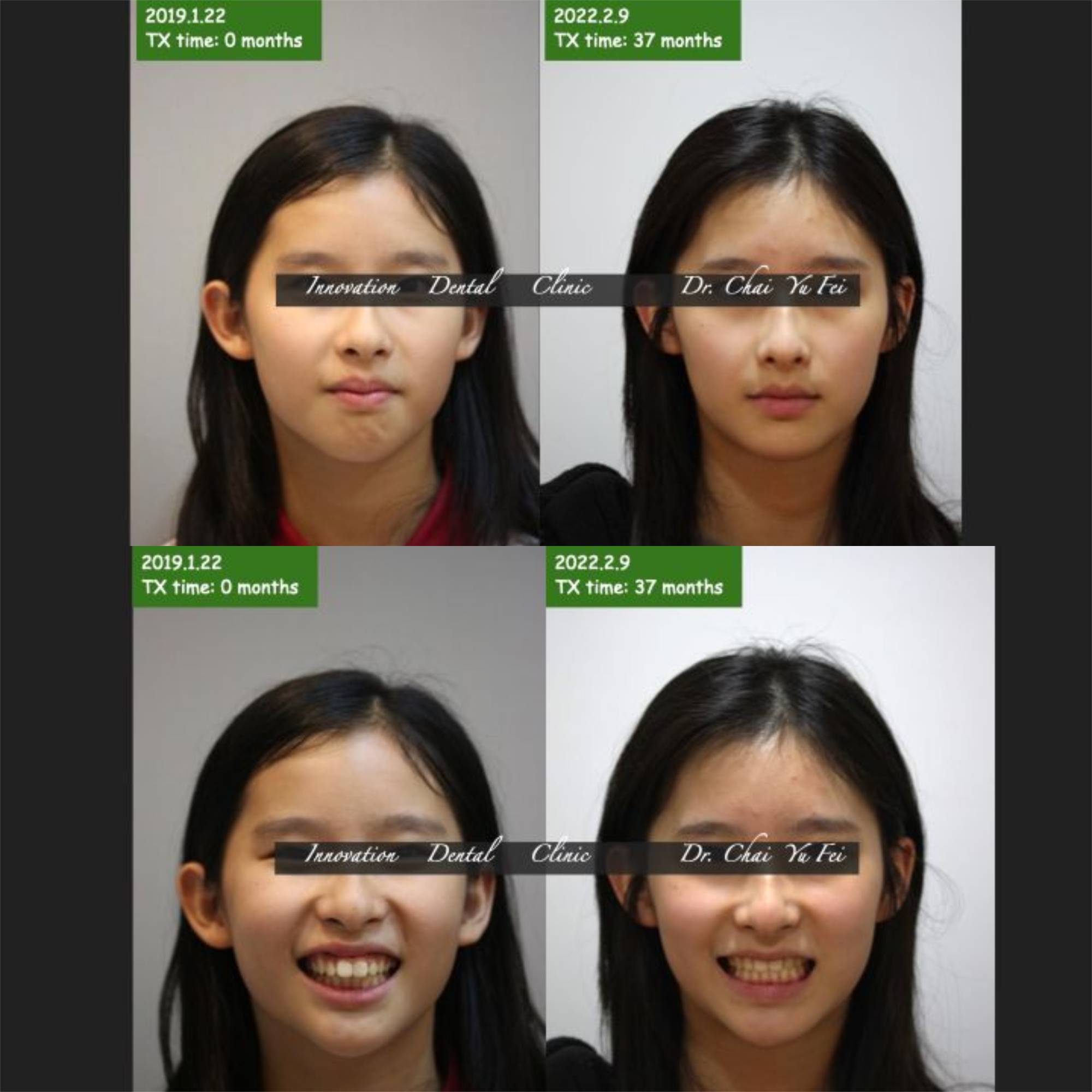 暴牙露牙齦案例