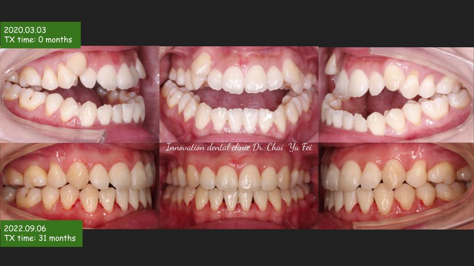 正顎手術成果示意圖