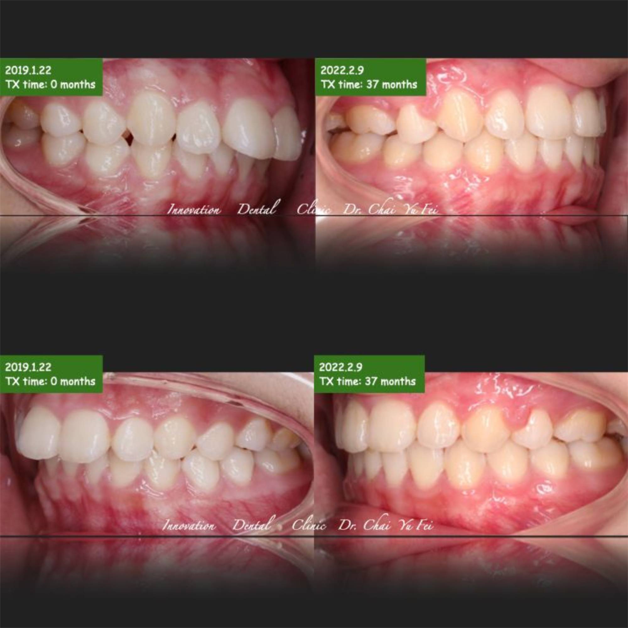 前排牙齒暴牙矯正