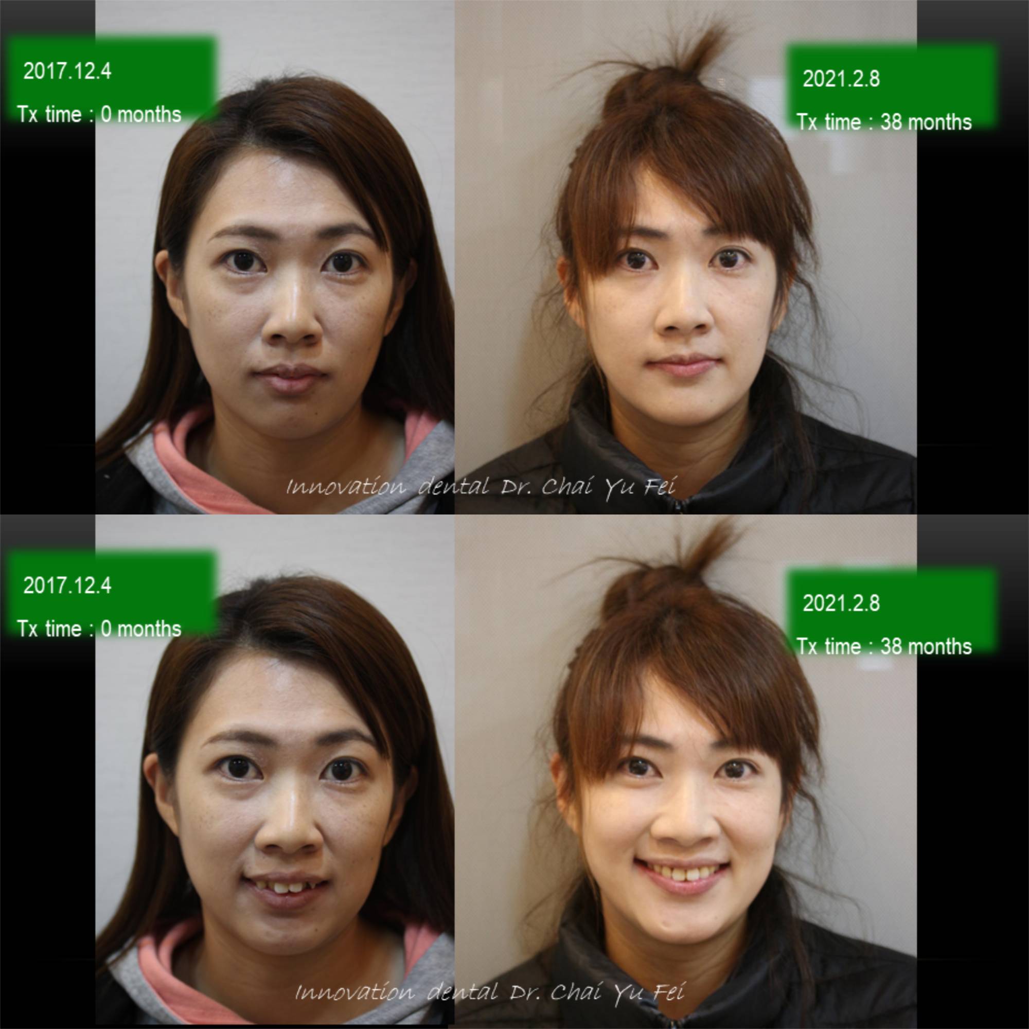 黃小姐拔牙矯正案例