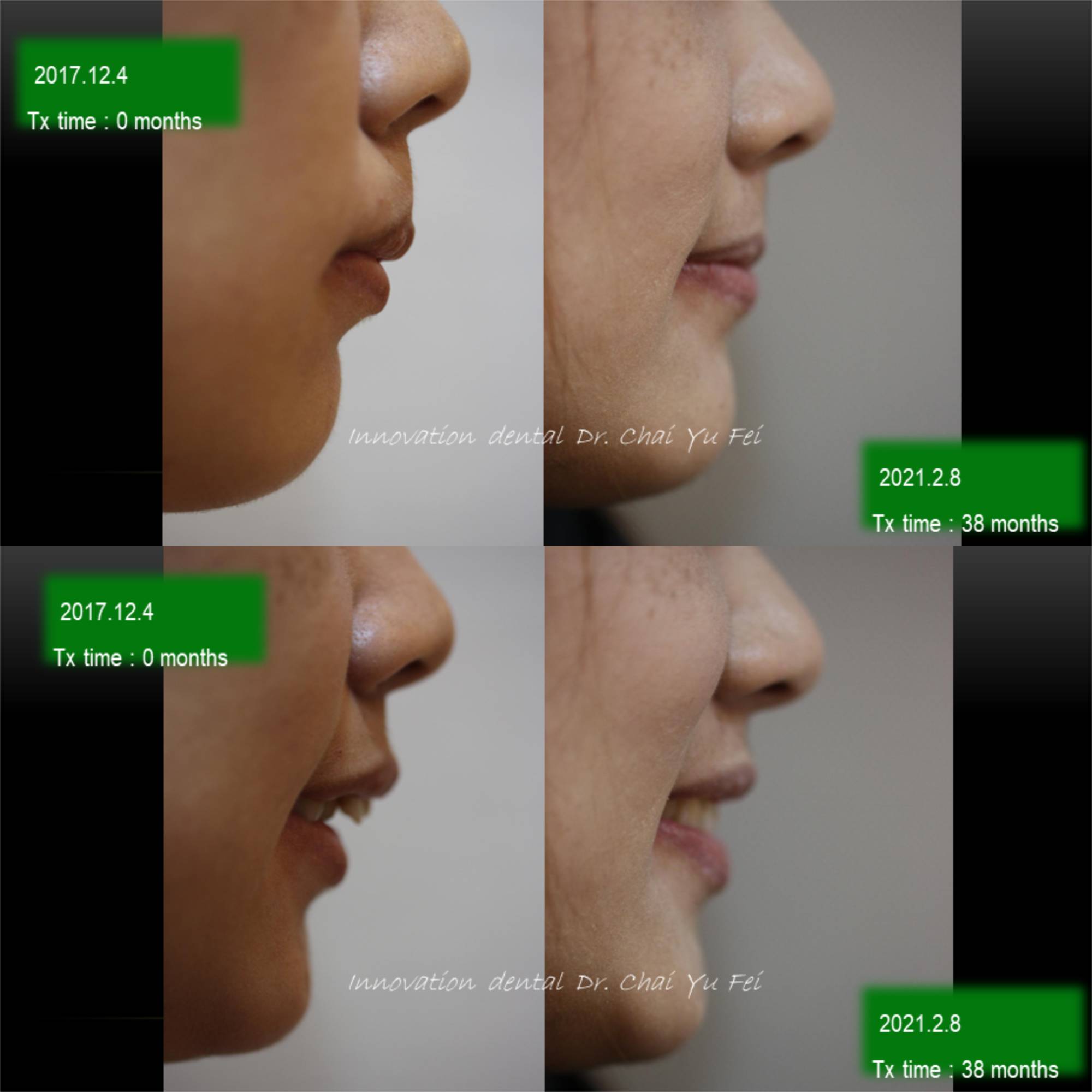 拔牙矯正案例：側門牙擁擠矯正