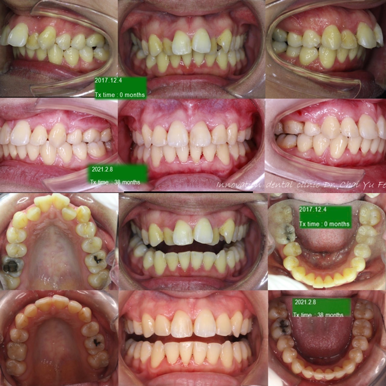 拔牙矯正案例照片