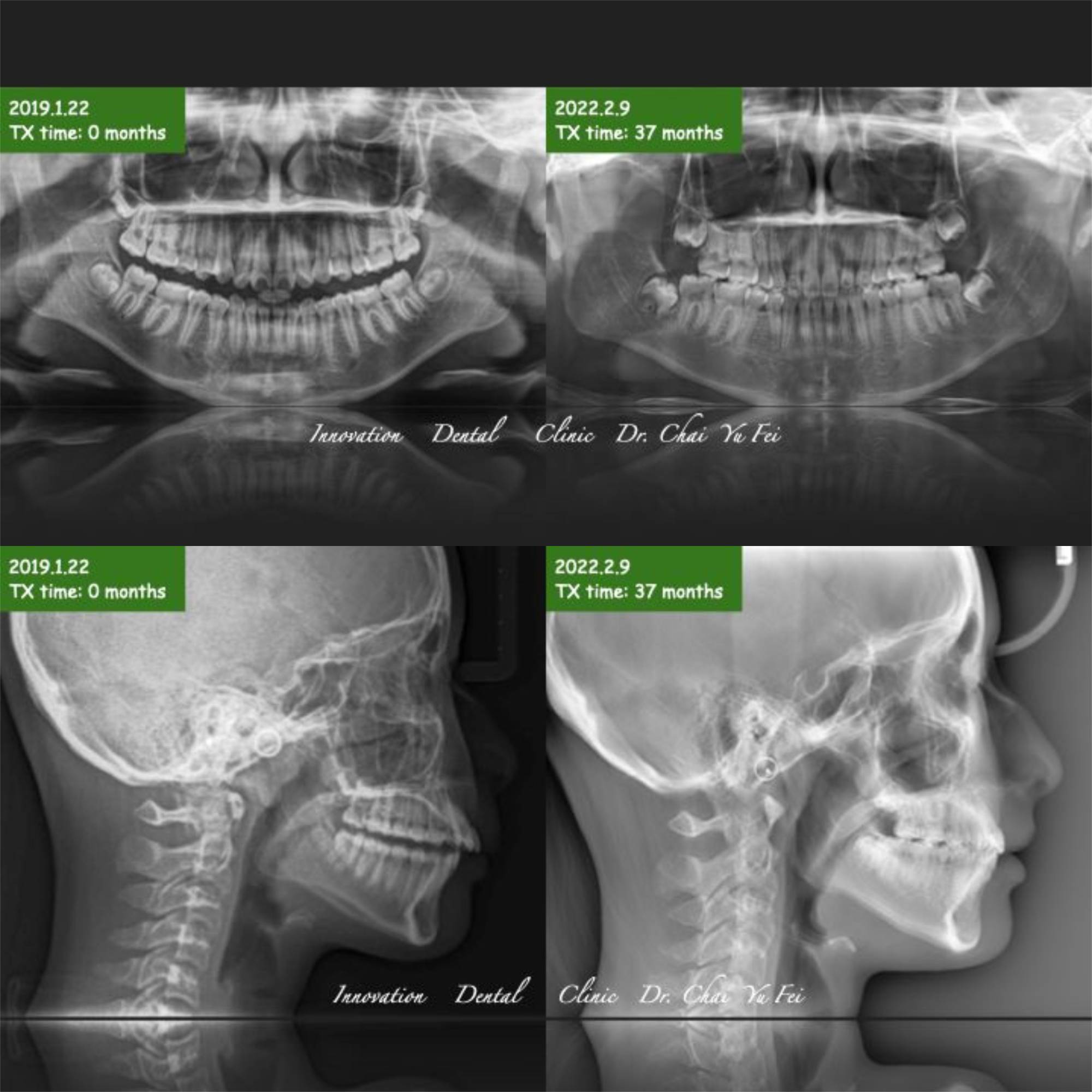暴牙矯正：齒性暴牙案例