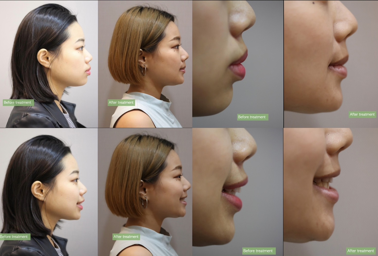 拔牙矯正側面照