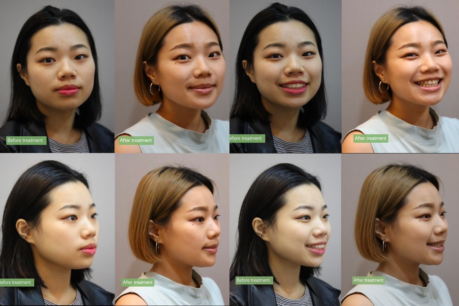 拔牙矯正成人案例分享