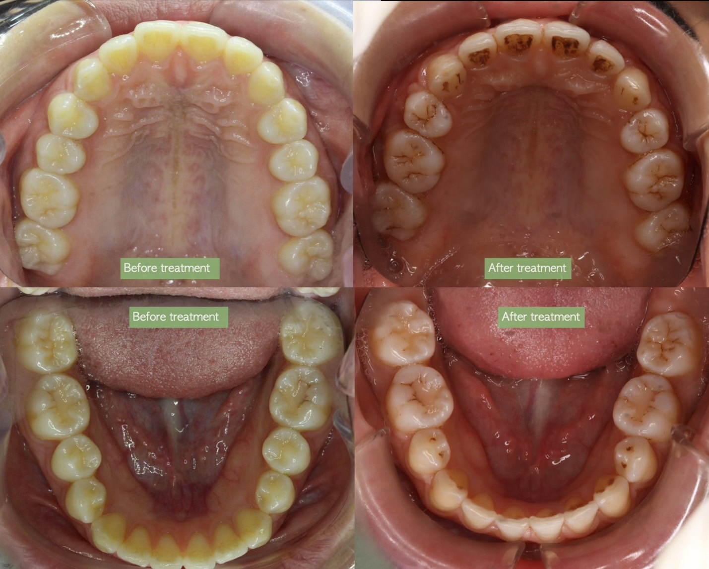 拔牙矯正案例分享