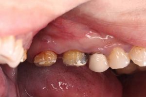 中度牙周病需要牙周病手術治療