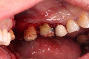 牙周病手術流程：清除牙根表面細菌、組織和結石