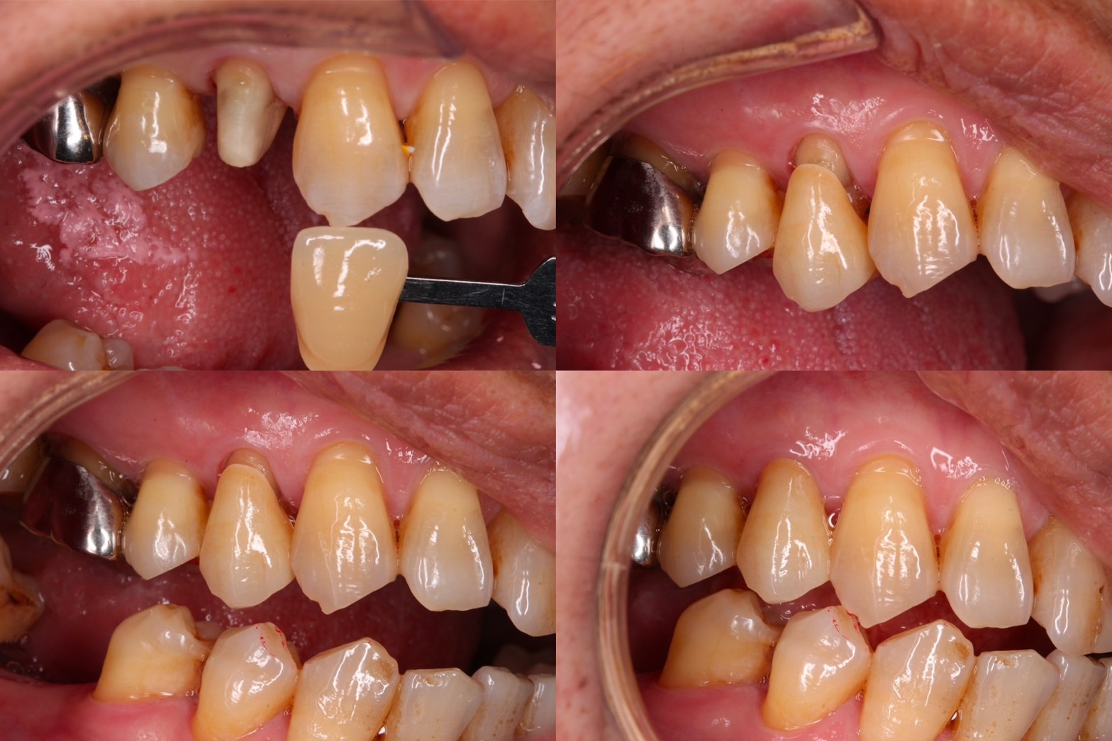 固定假牙種類:單顆牙冠