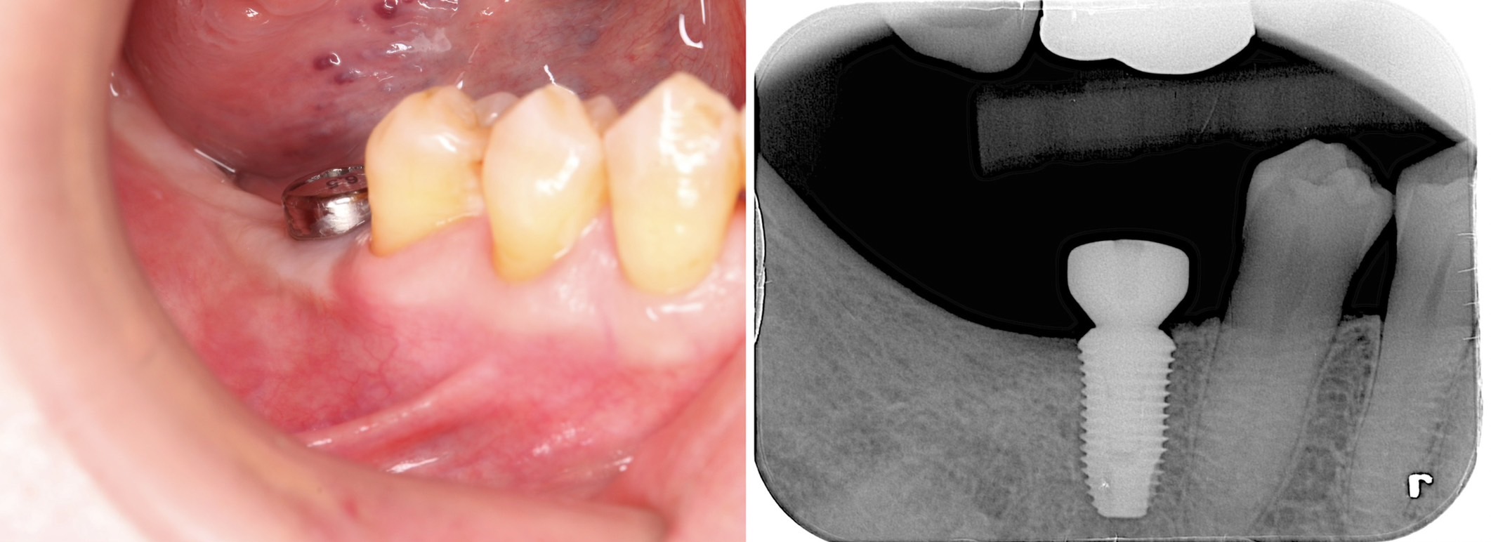 固定假牙:植牙需要植入人工牙根