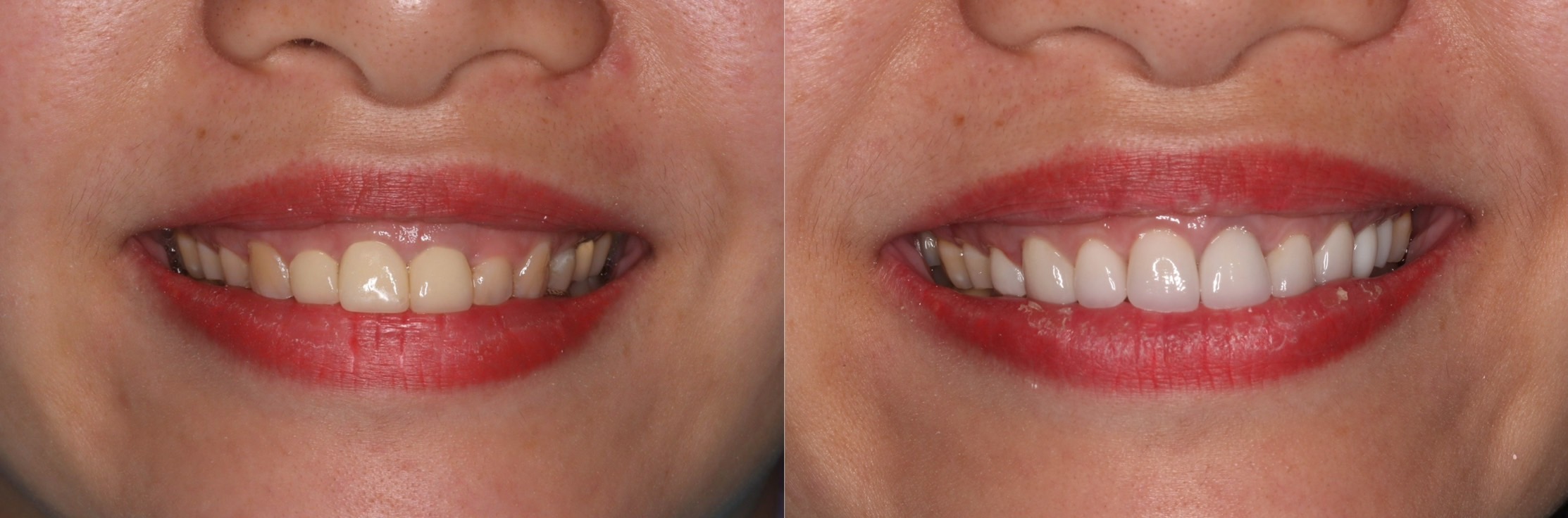 固定假牙種類:陶瓷貼片