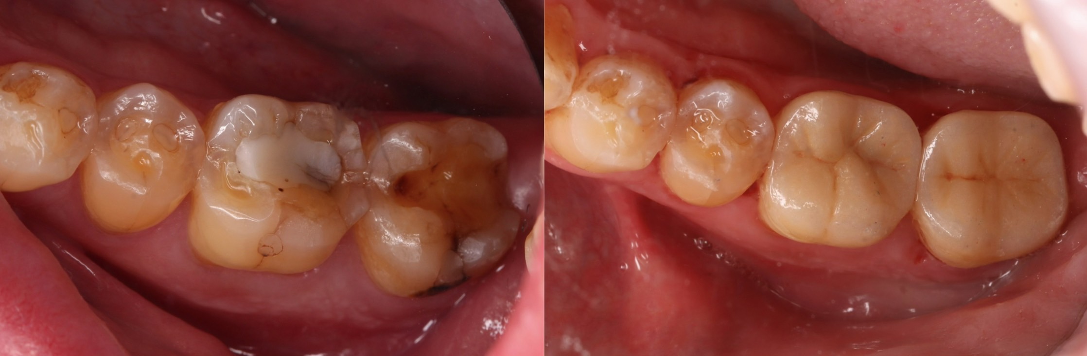 固定式假牙:齒雕