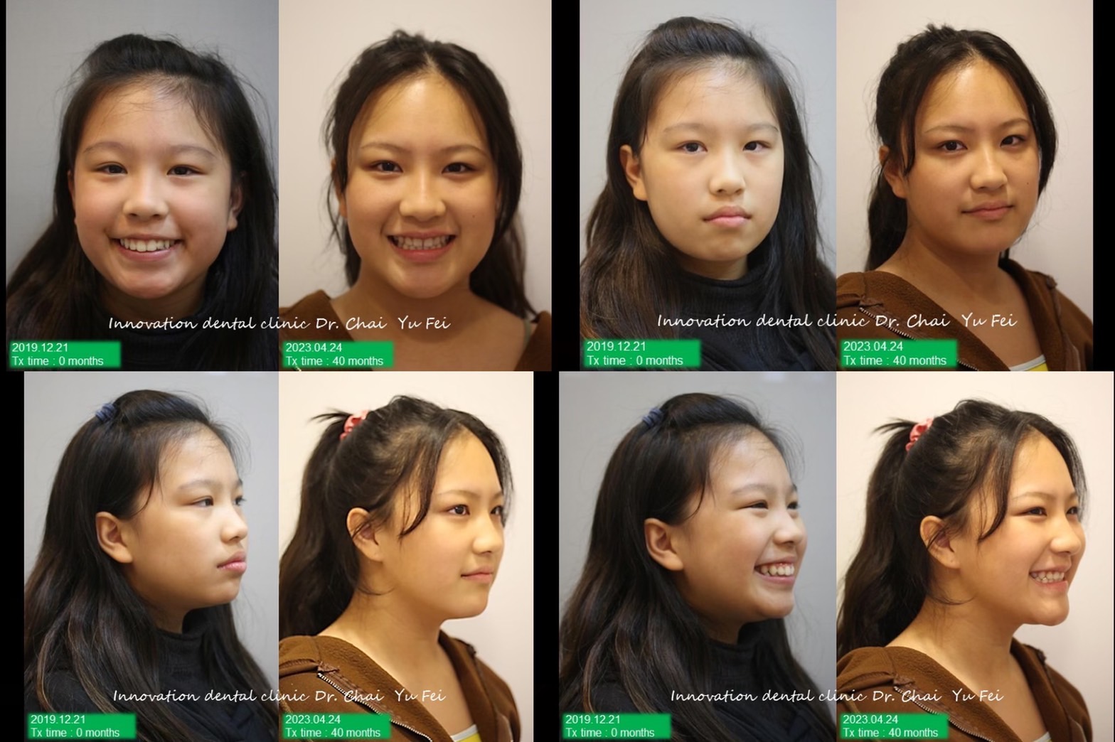 矯正外觀輪廓改變拔牙案例