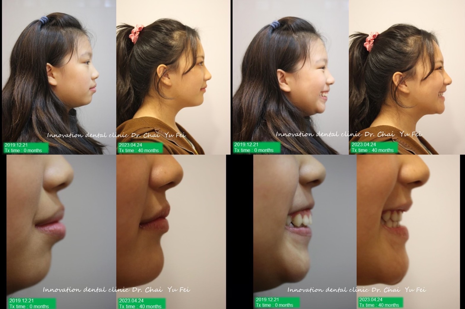矯正外觀輪廓改變同學拔牙案例