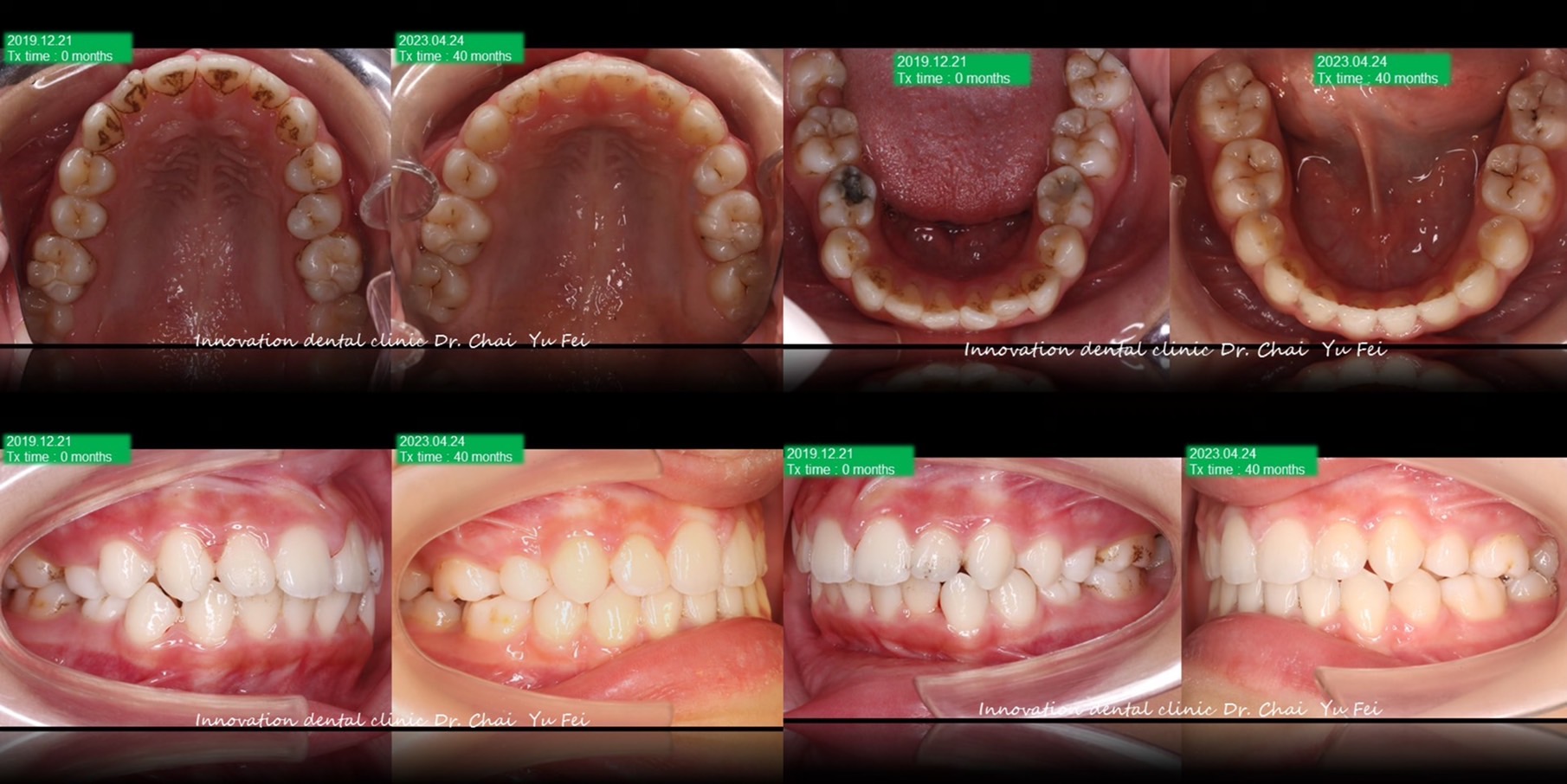 矯正外觀輪廓改變拔牙案例分享