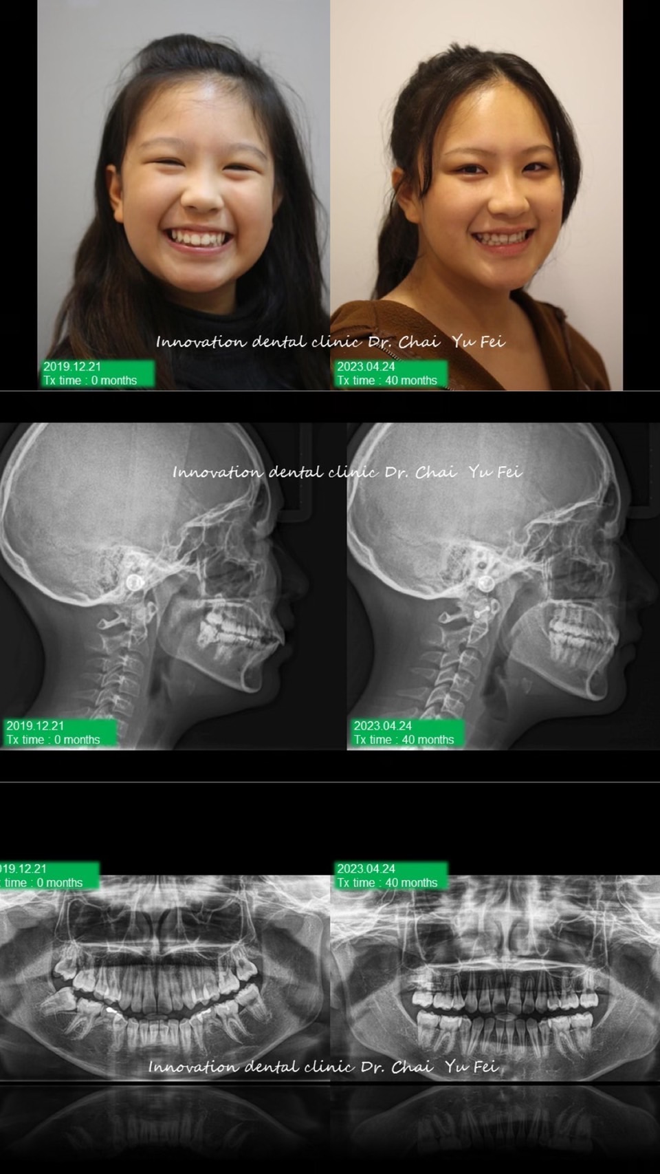 矯正外觀輪廓改變曾同學拔牙案例分享