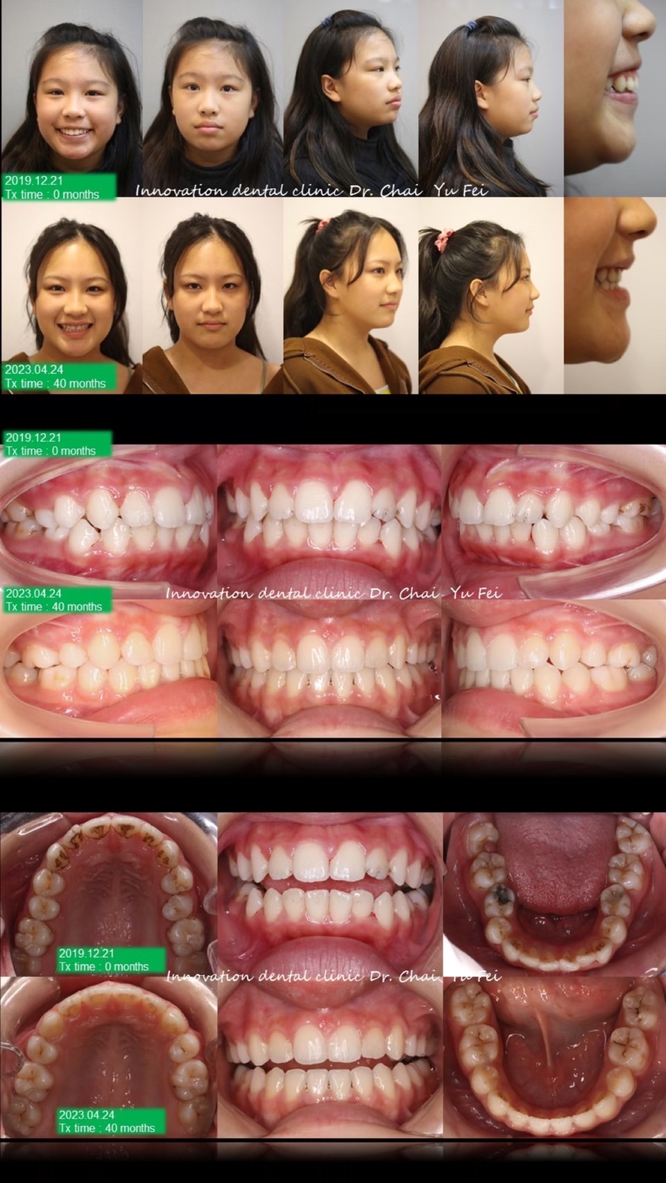 矯正不僅可以將牙齒扶正，還能連外觀輪廓一起改變？曾同學拔牙案例分享