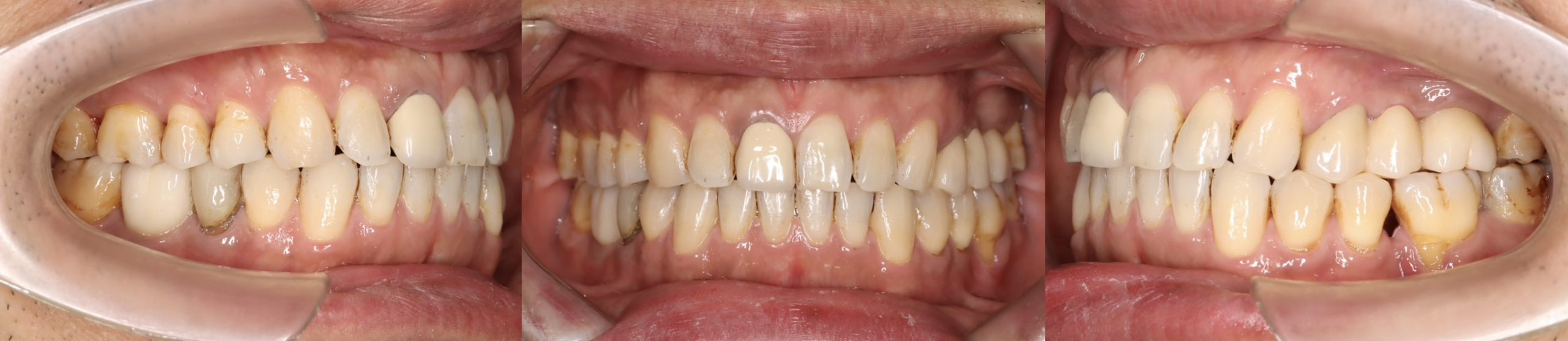 成人矯正全口重建