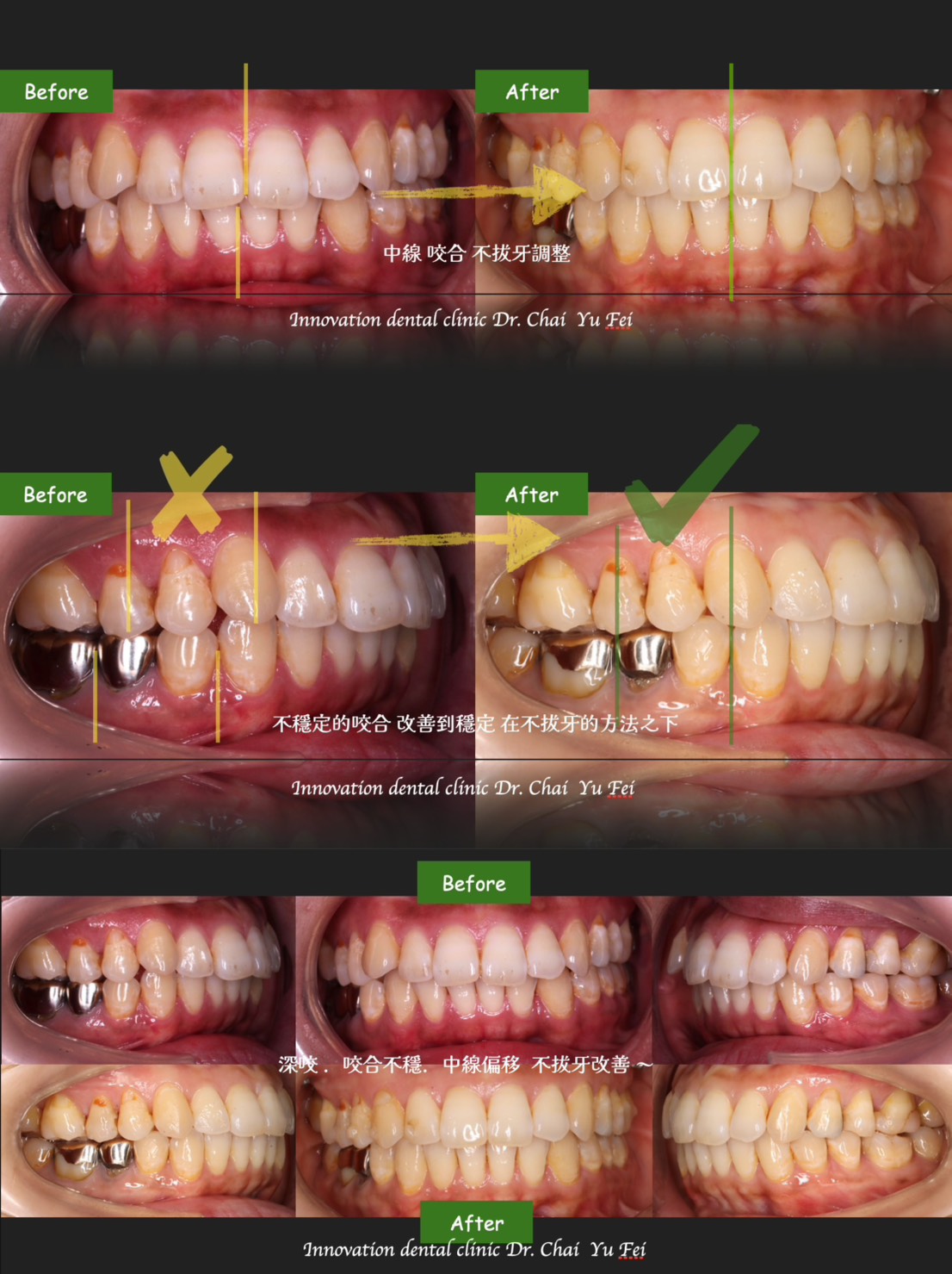 【台日跨國隱形矯正案例分享】成功克服地區與疫情限制-日本患者