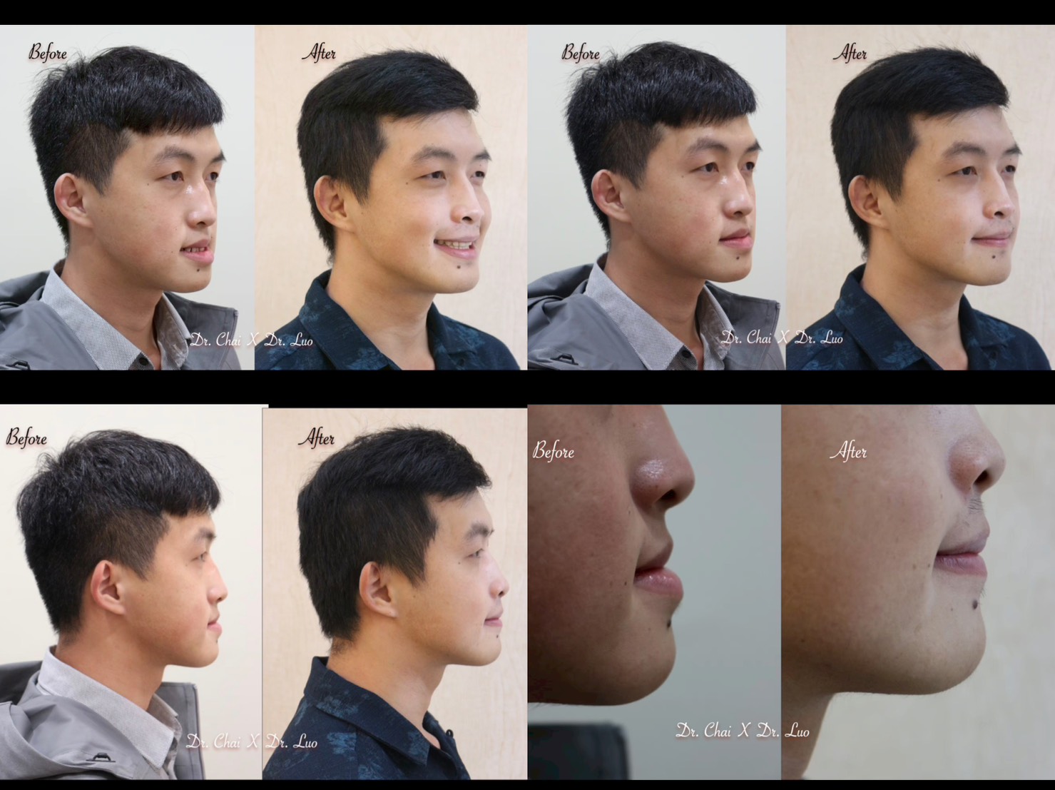 OGS正顎手術合併矯正治療案例分享