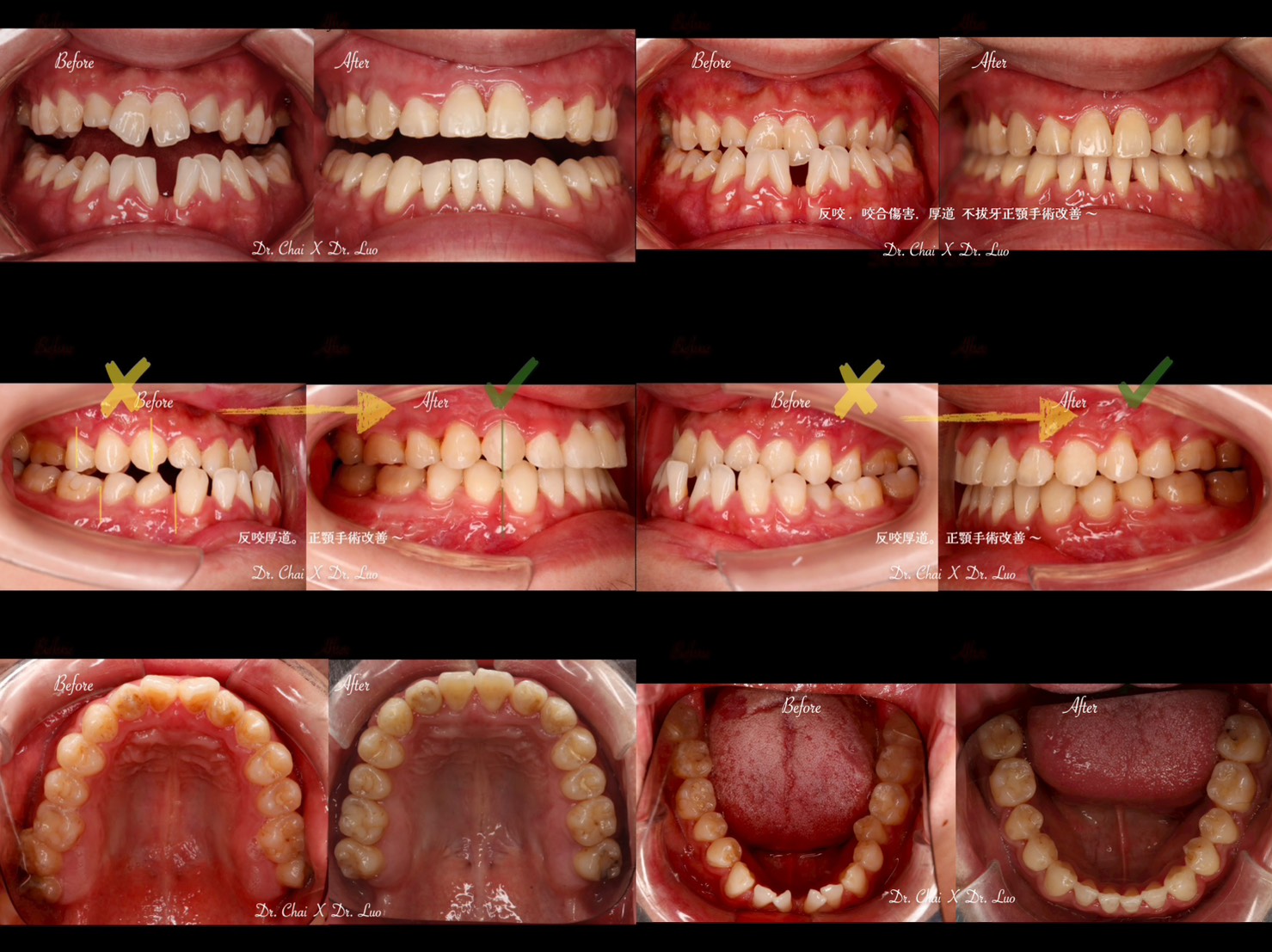 正顎手術合併矯正治療案例分享