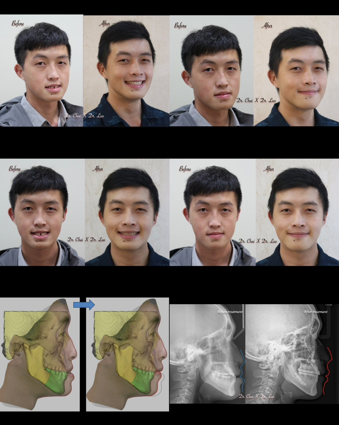 OGS正顎手術合併矯正治療案例分享改善厚道臉歪