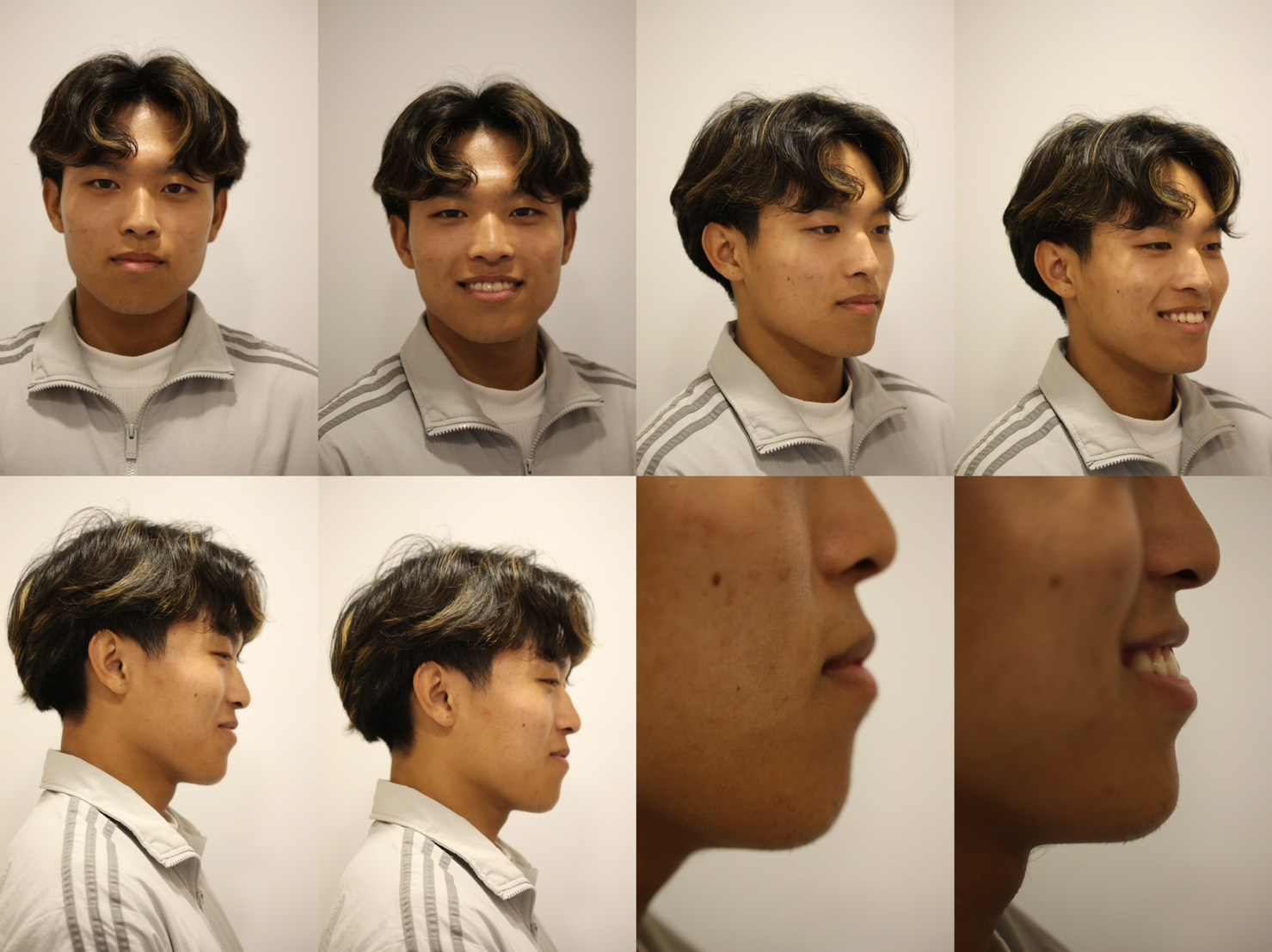 林口功能性矯正MRC治療10年追蹤