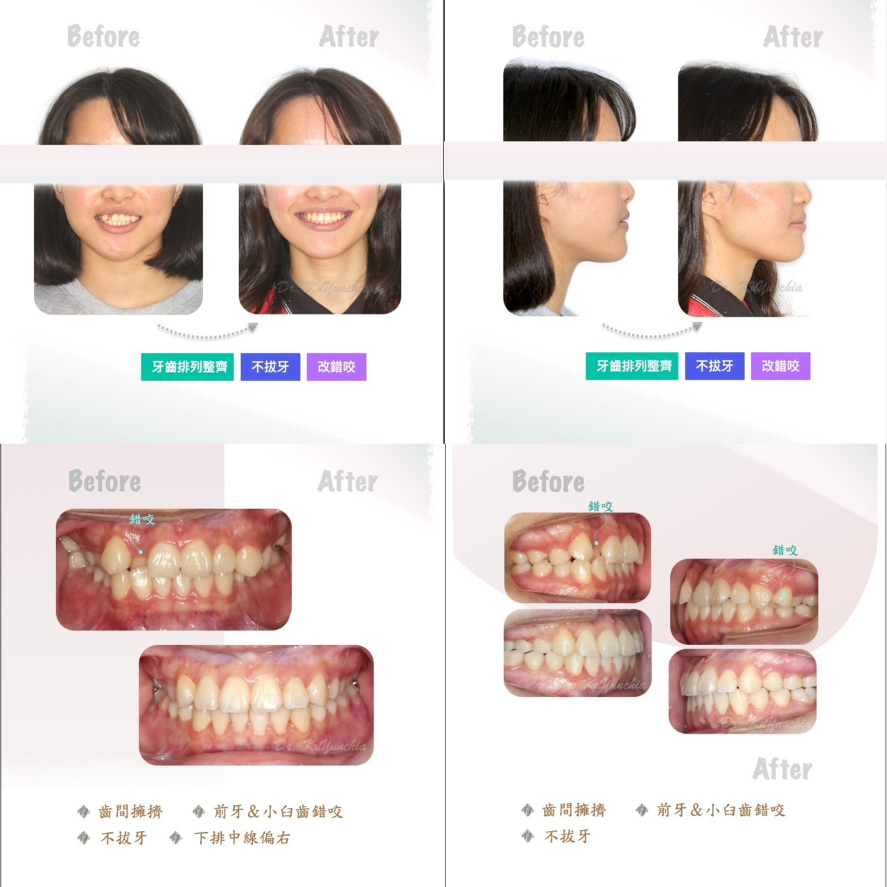 古芸家醫師矯正案例分享|不拔牙、錯咬、深咬、凸嘴改善,看看不同牙齒問題如何透過矯正找回理想笑容