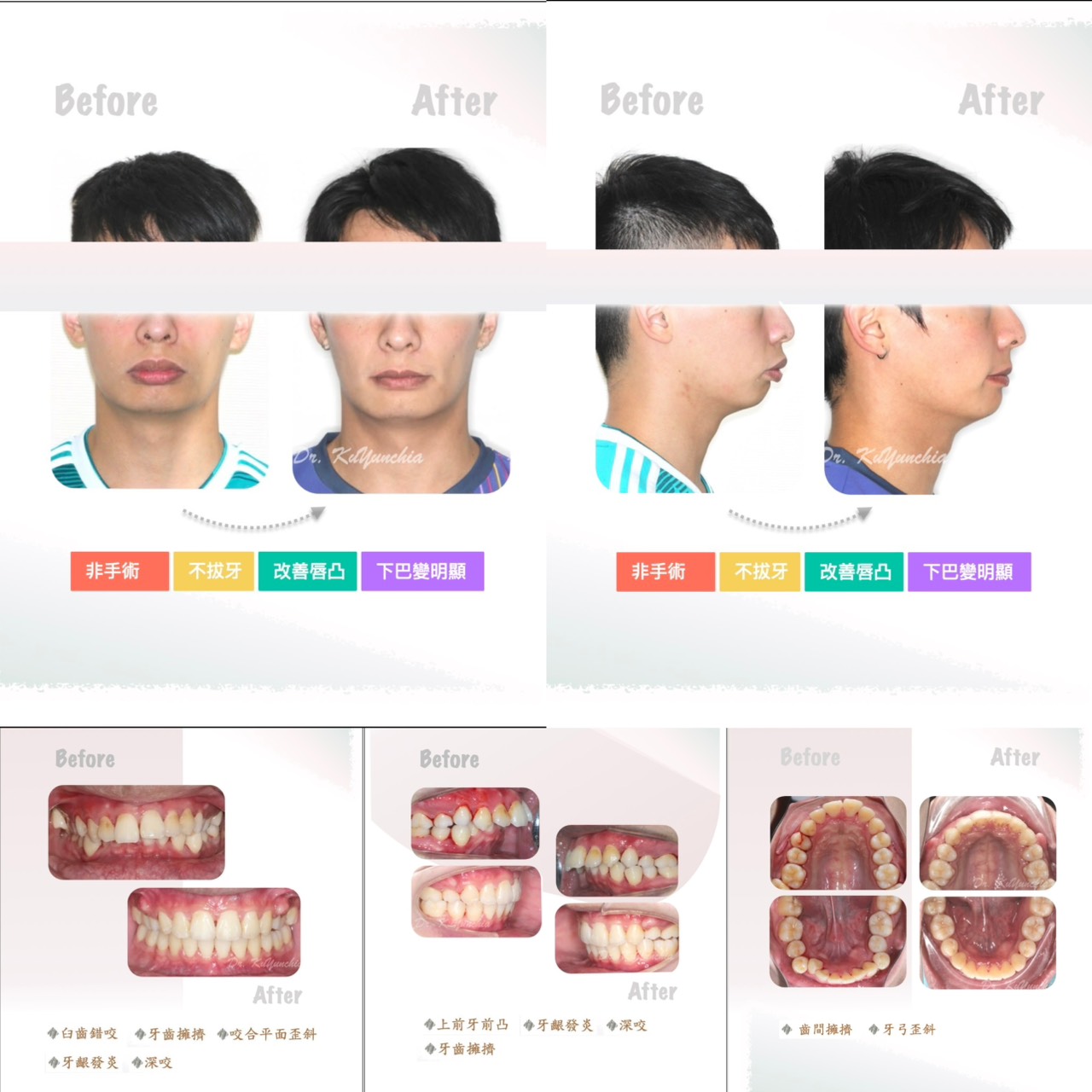 古芸家醫師矯正案例分享|不拔牙、錯咬、深咬、凸嘴改善,不同牙齒問題如何透過矯正找回理想笑容