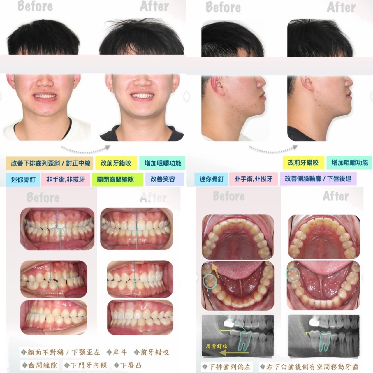 下顎過長合併前牙錯咬案例分享|不拔牙矯正搭配迷你骨釘改善齒列